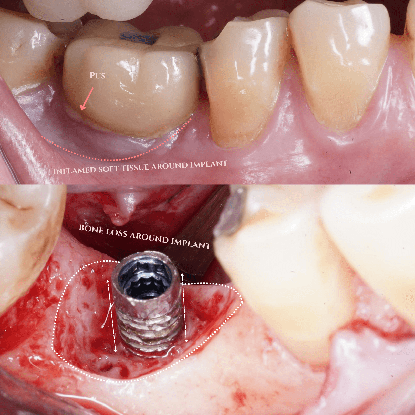 Clinical composite: upper preoperative view with inflamed tissue around an implant crown; lower surgical view showing the exposed implant and surrounding bone defect after debridement.