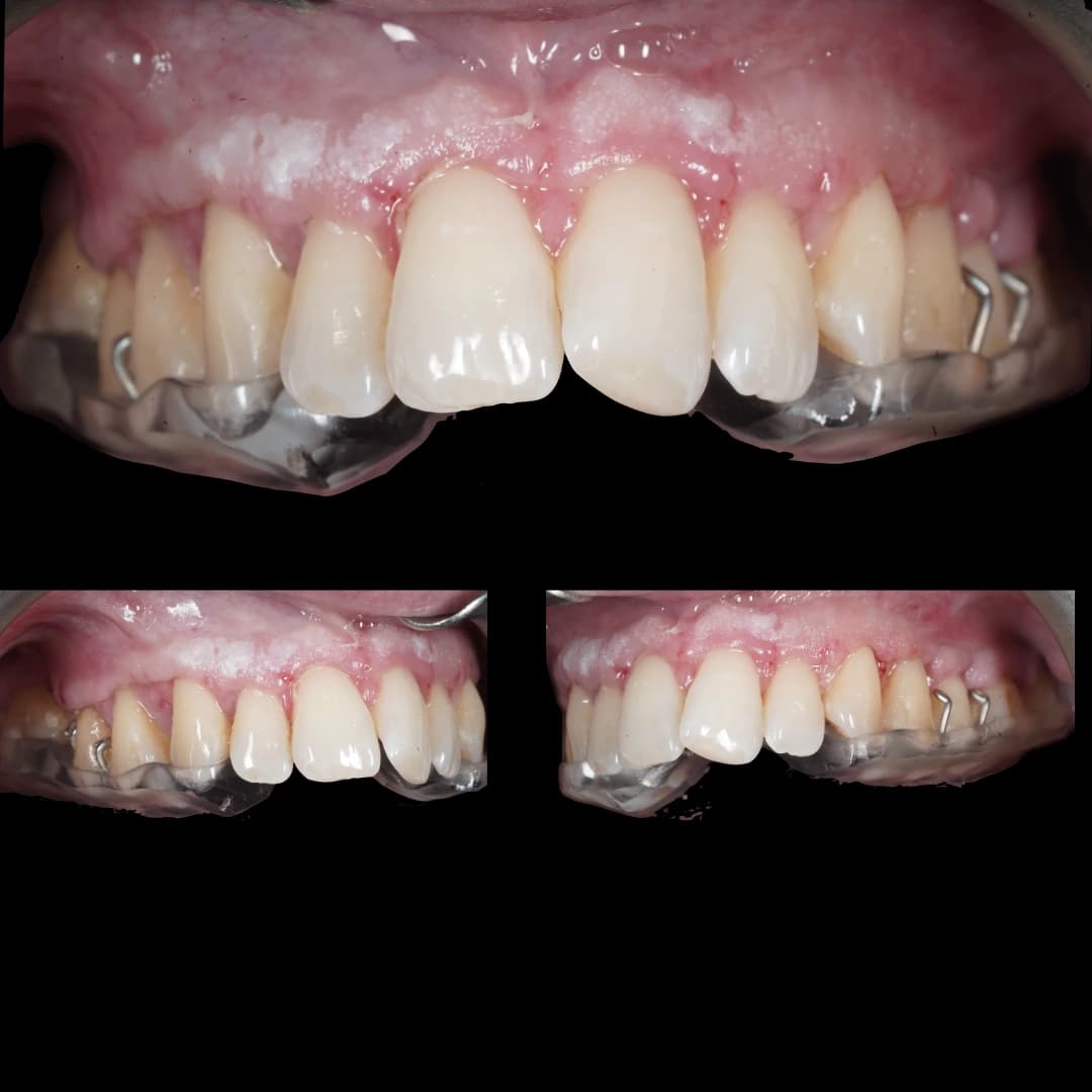 Composició de vistes frontals i laterals a les dues setmanes de la corticotomia, amb l’aparell d’expansió ortodòntica encara col·locat