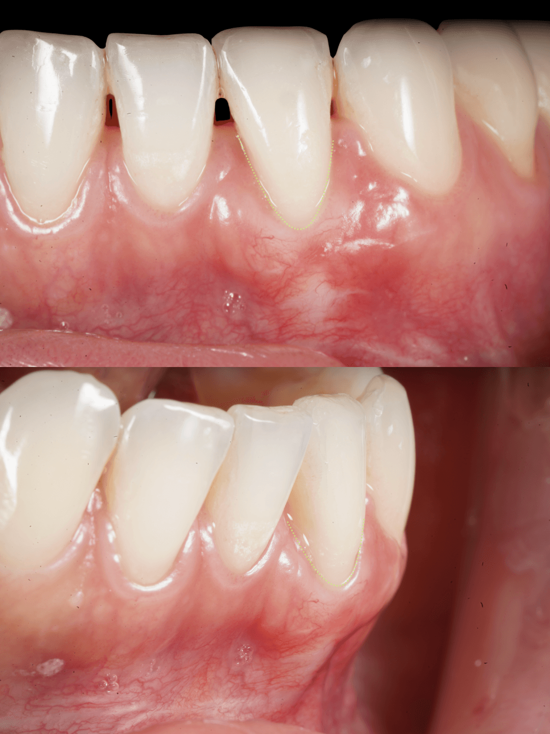 Frontal and side clinical photographs of the lower front teeth at the three-month review after periodontal treatment, with the original dotted annotations