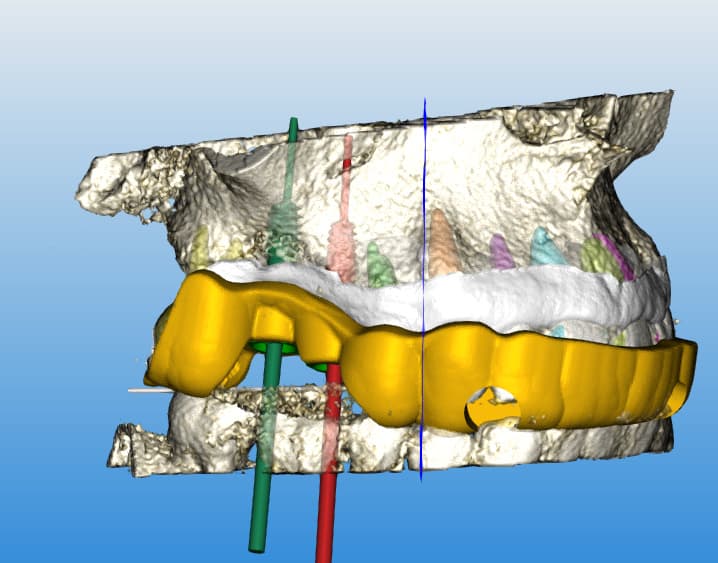 Guided Implant Surgery