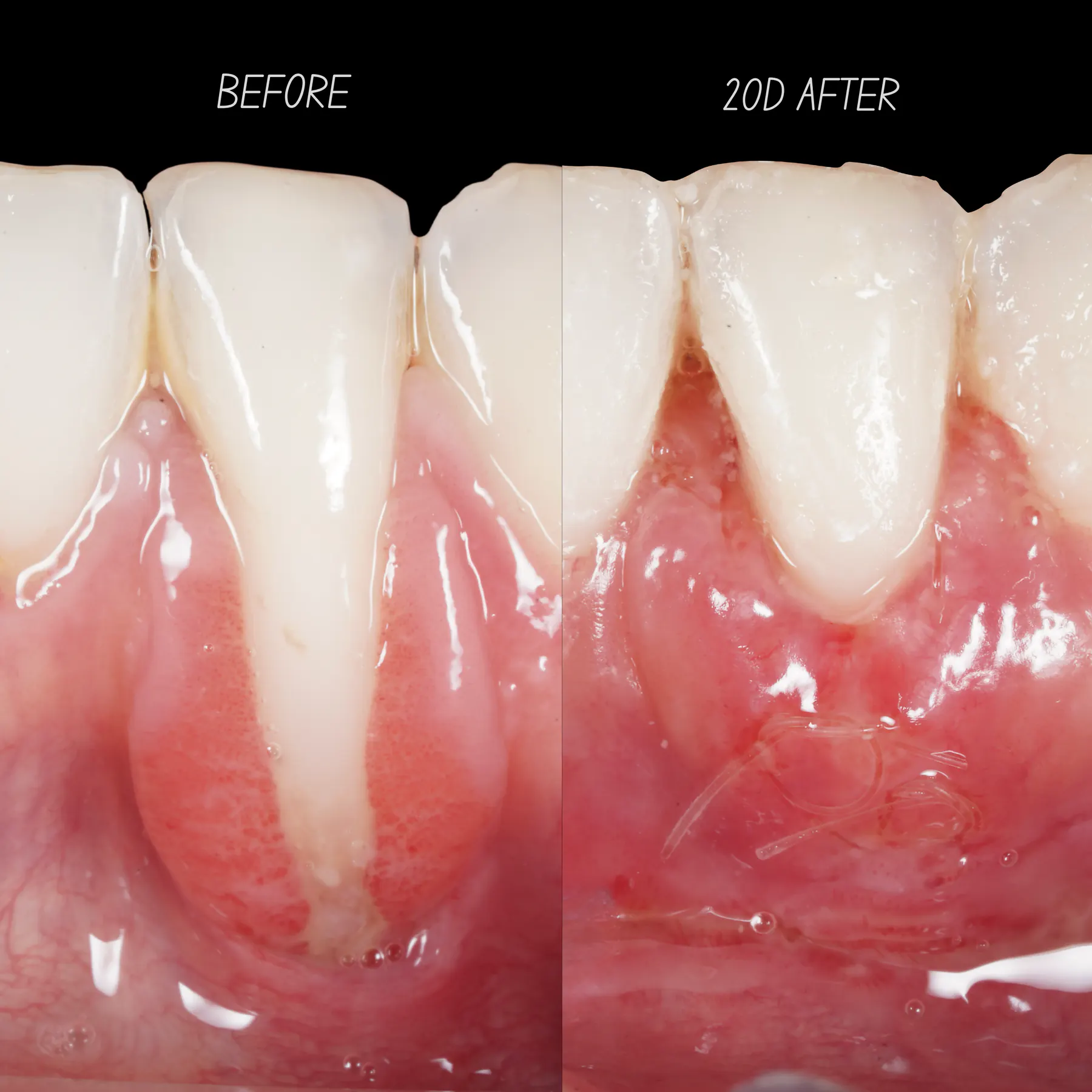 Severe Recession Case: Root Coverage and Tissue Reinforcement