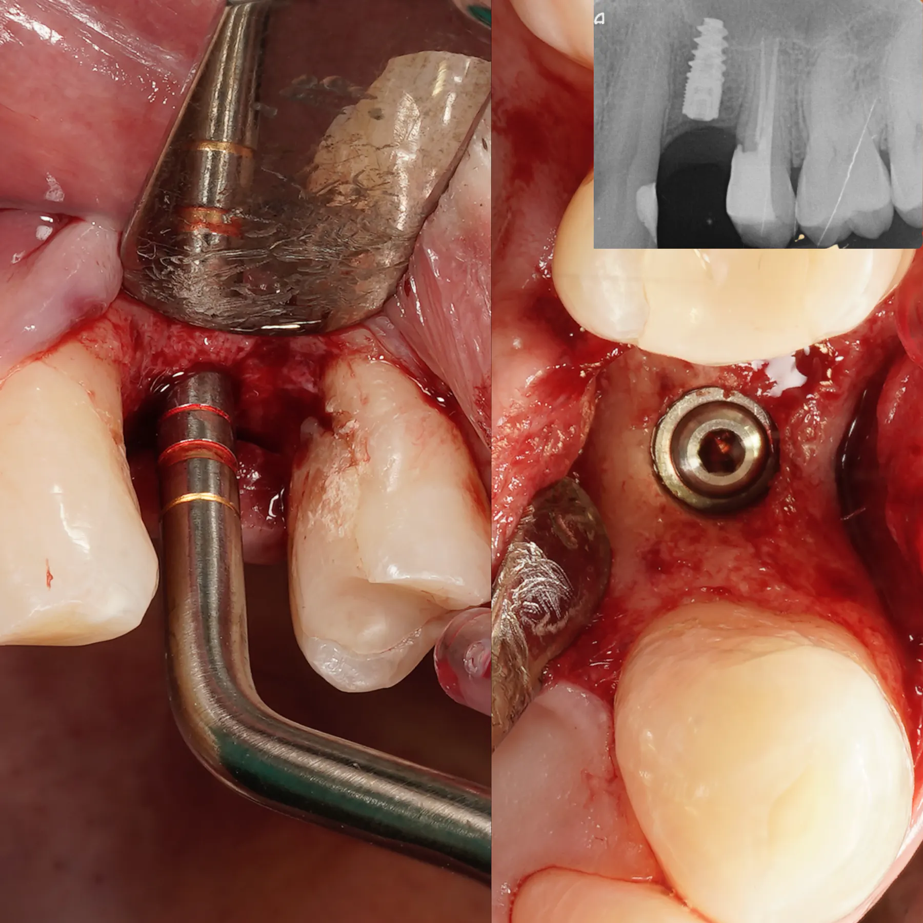 Sinus Lift & Posterior Maxilla Implant Planning