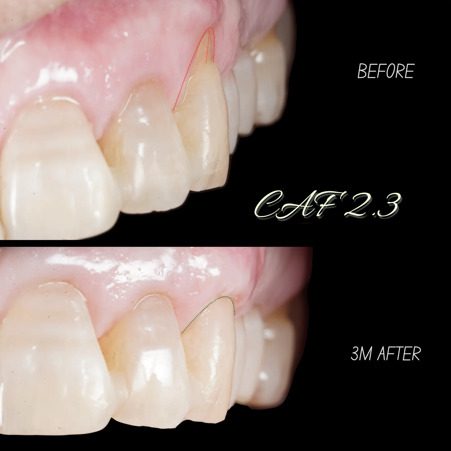 Corrective Root Coverage After Previous Failed Recession Surgery