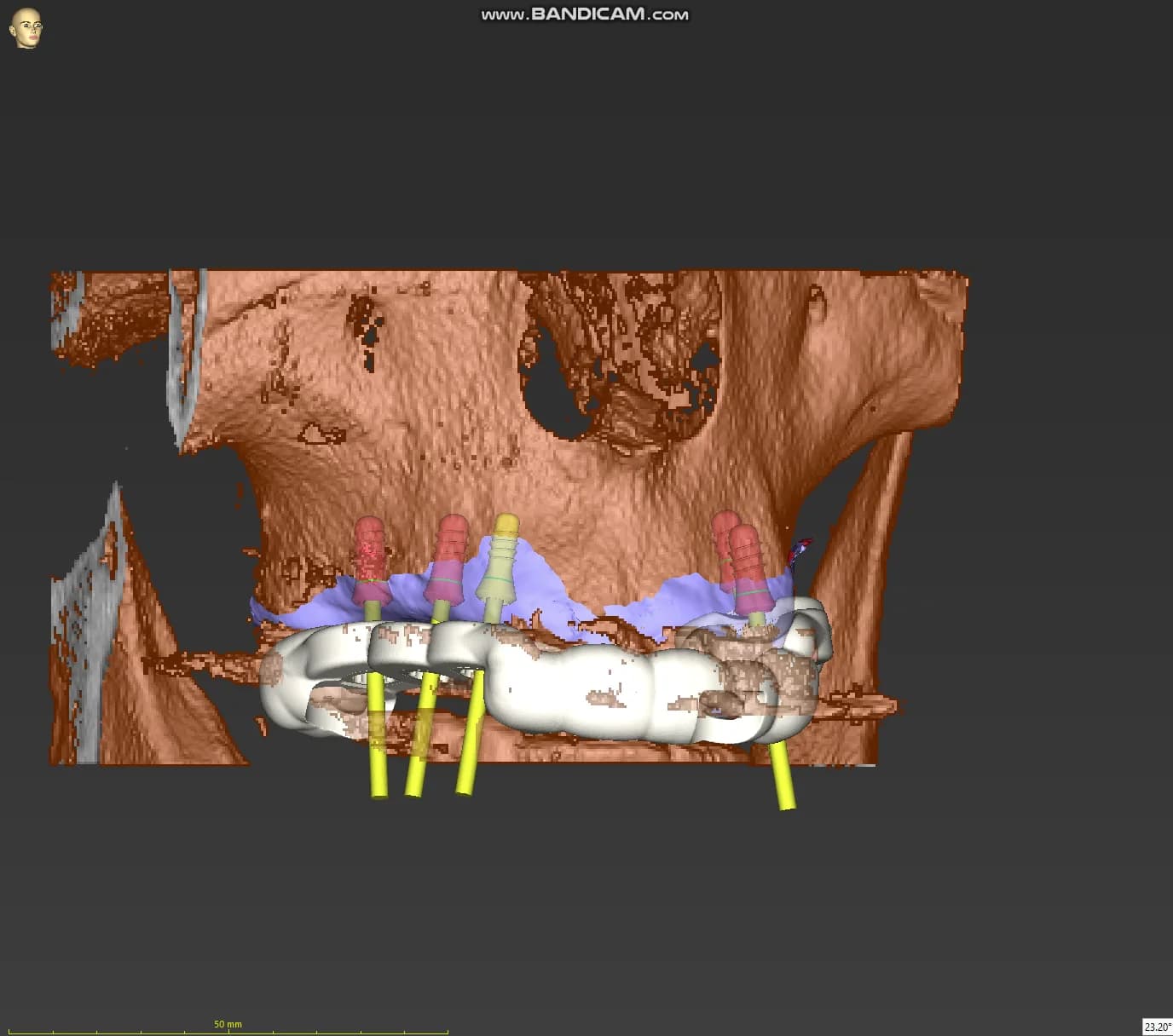 An upper-jaw planning model for two separate bridges, supported by three implants and two implants, with bone anatomy and guide components