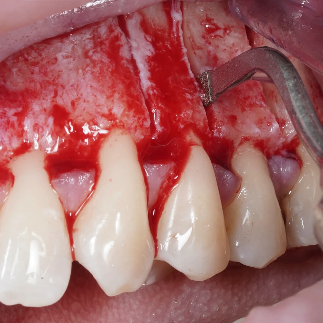 An exposed maxillary surgical site with the guide removed and a piezoelectric tip following a marked cortical line