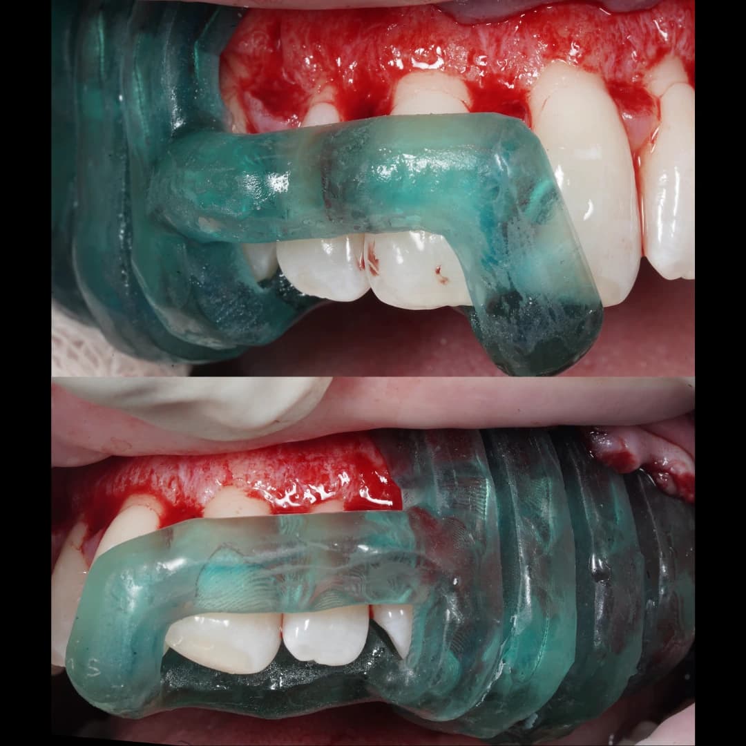 Dues vistes intraoperatòries: la guia de corticotomia dreta assentada a la fotografia superior i l’esquerra a la inferior