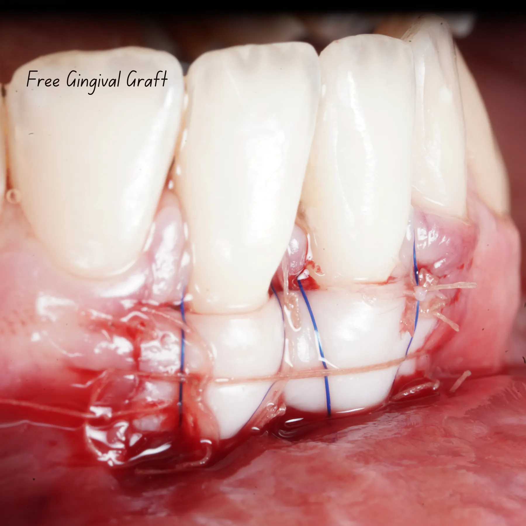 Soft Tissue Grafting Around Teeth & Implants