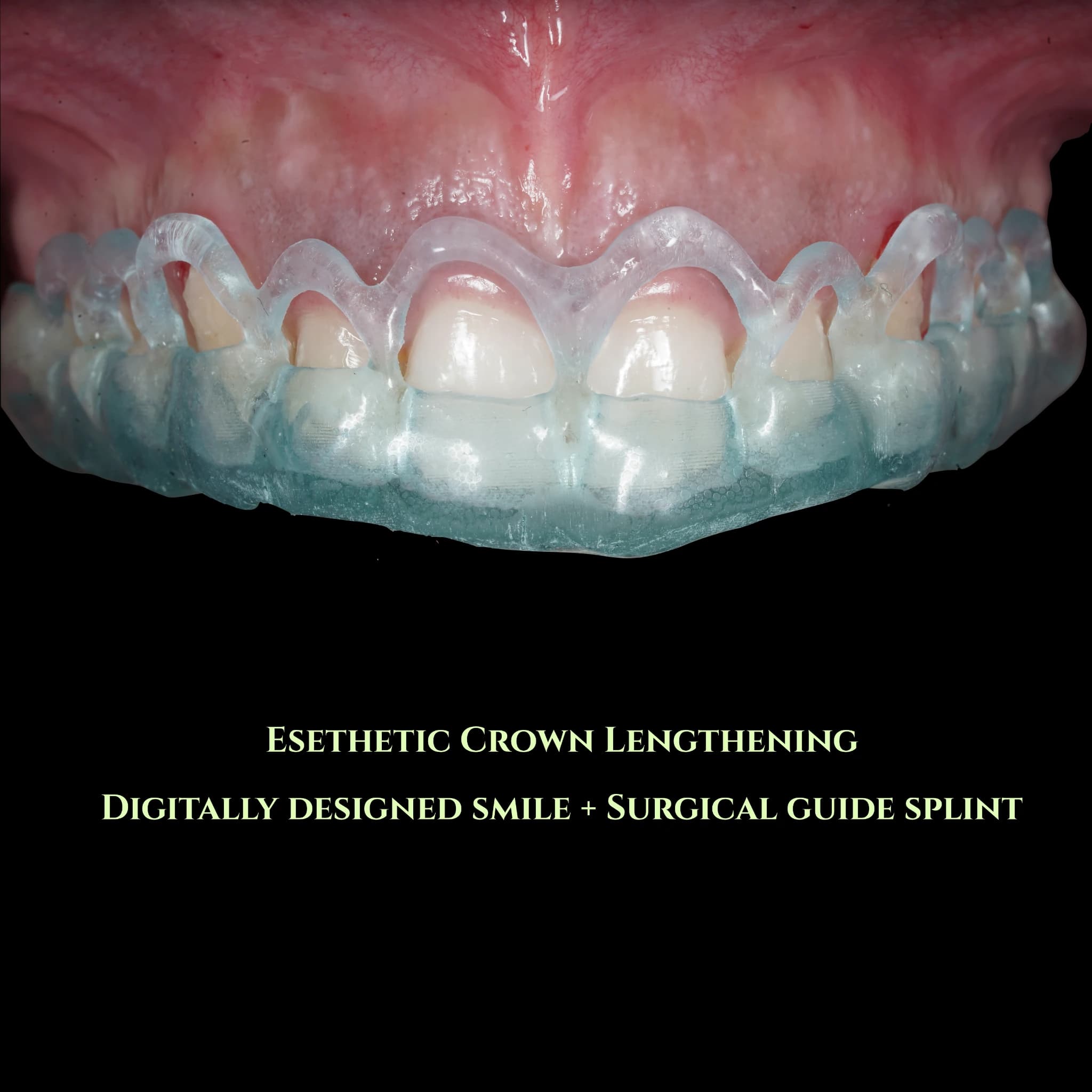 Digitally planned gingivectomy and crown lengthening guide positioned before periodontal surgery