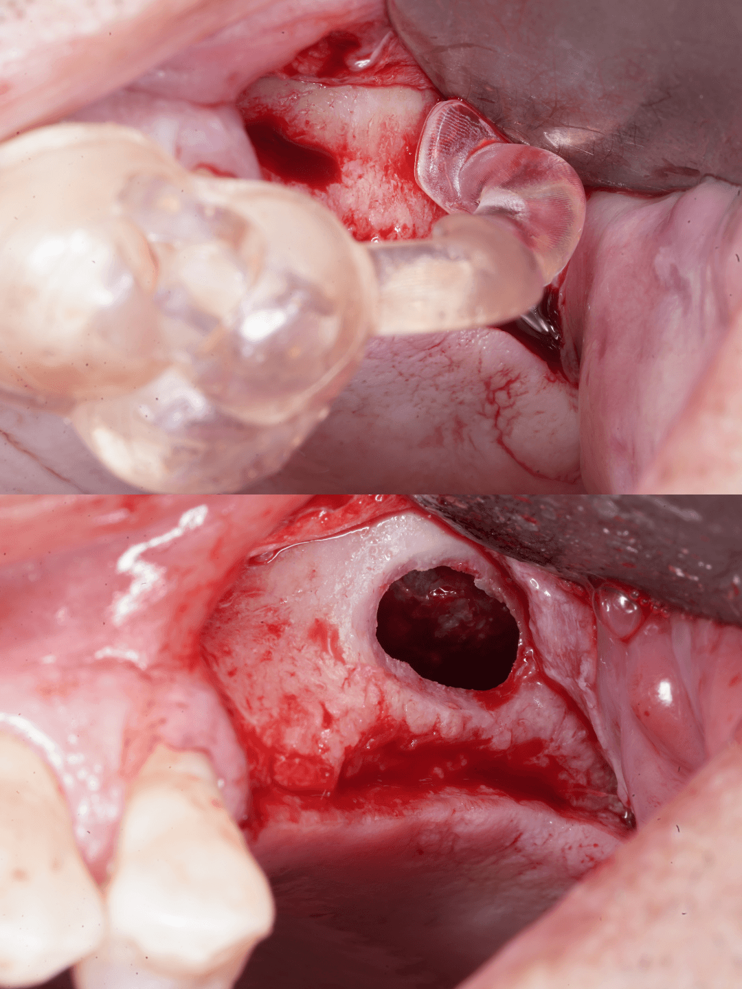 Two surgical photographs: the sinus guide in position above, and the lateral window after osteotomy below