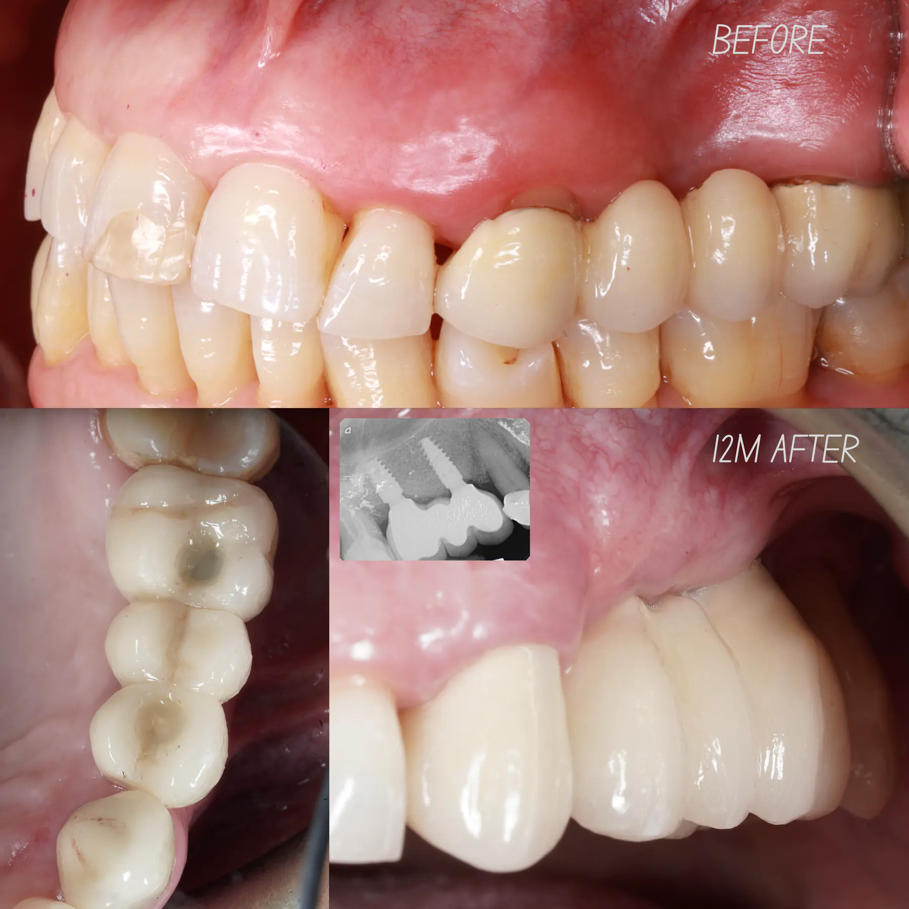 From Infection to Bone Regeneration and Implant Foundation