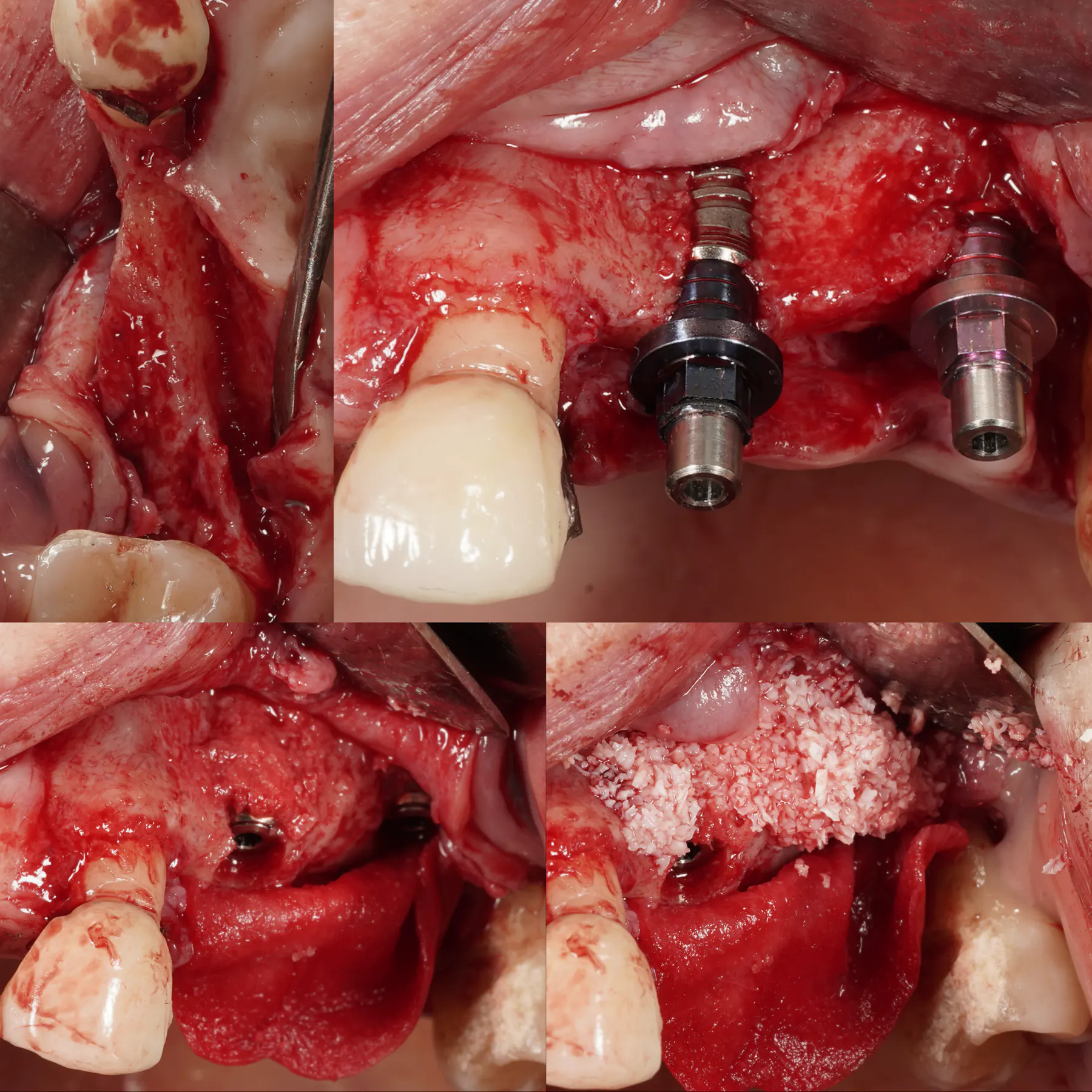 Bone and Gum Support After Infection-Related Tissue Loss
