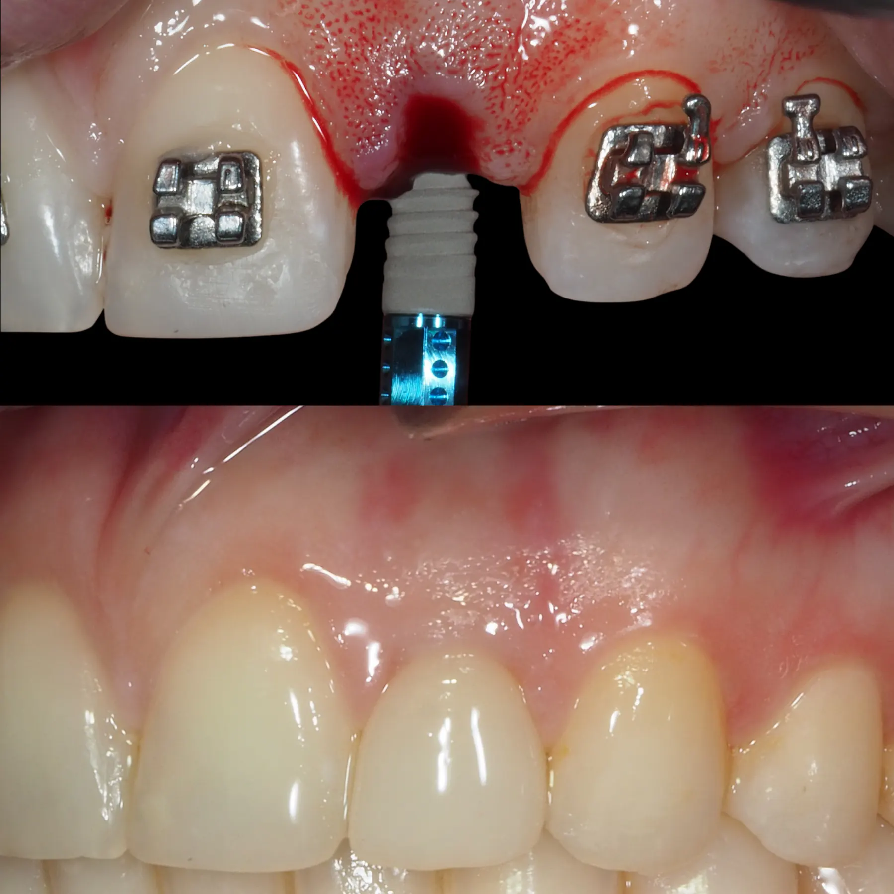 External Root Resorption Managed With Interdisciplinary Implant Planning