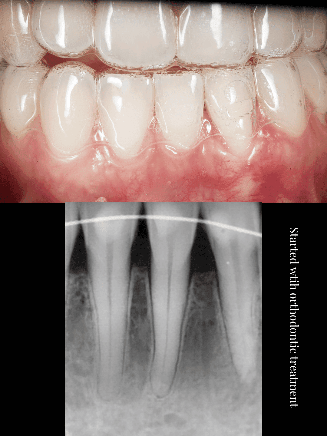 Clinical photograph with clear aligners at the start of Invisalign above a periapical radiograph taken before Invisalign began