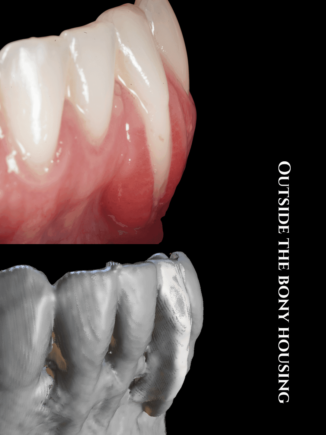 Pre-treatment side-view clinical photograph of the lower front teeth above a three-dimensional CBCT-based view of the teeth and surrounding bone