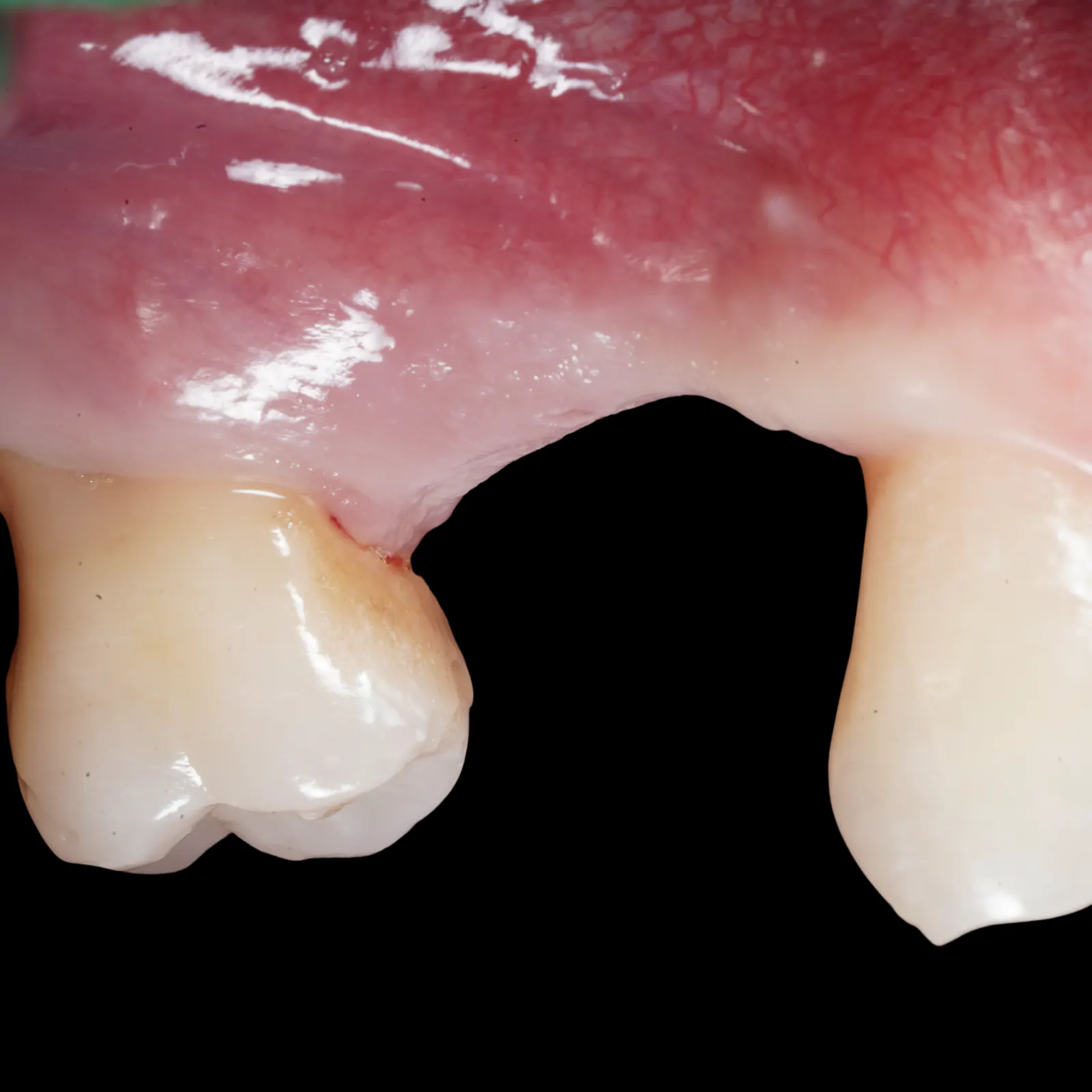 Sinus Lift and Implant Placement in One Surgical Phase