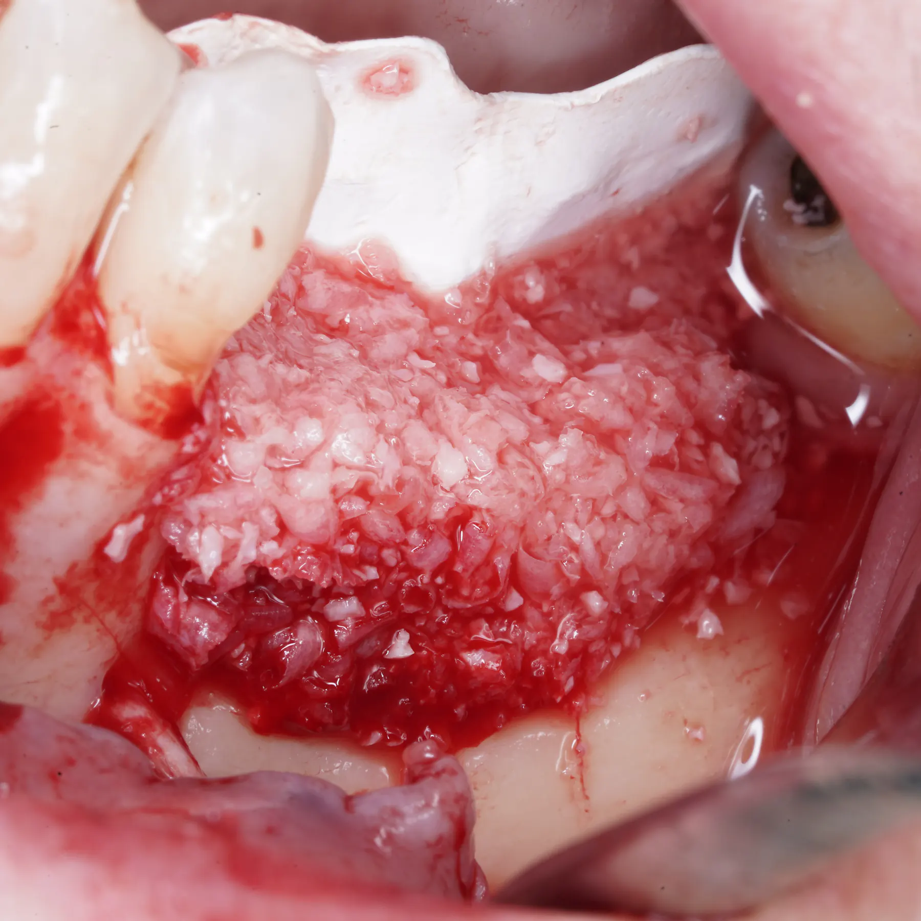 Vertical Bone Regeneration