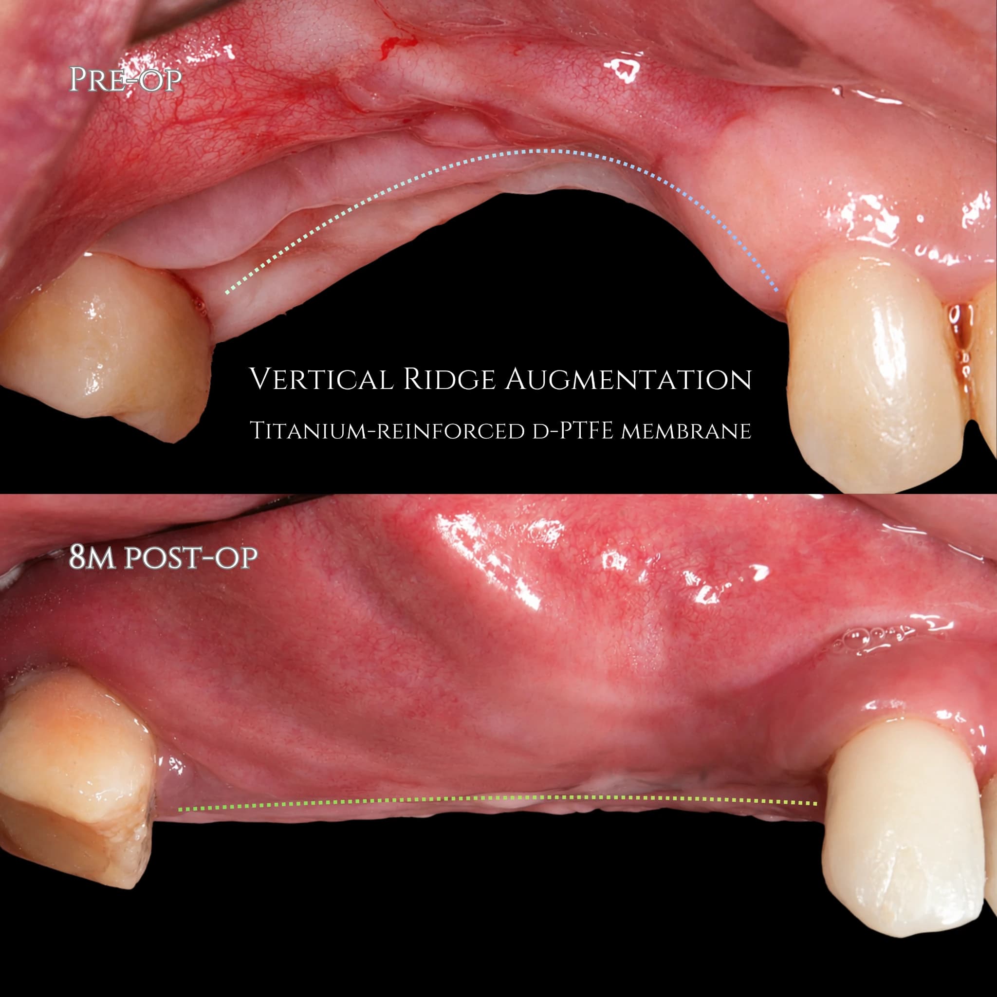 Vertical Bone Regeneration After Implant Loss in the Posterior Maxilla